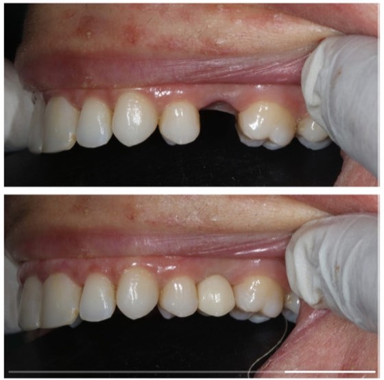Immediate implant placement: before and after