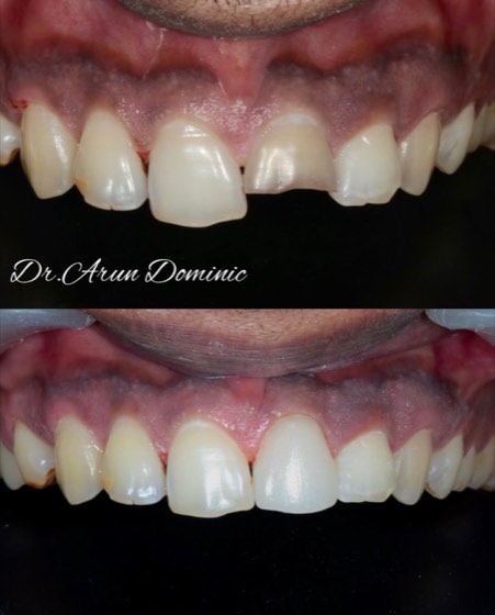 Same-day CAD/CAM crown: before and after