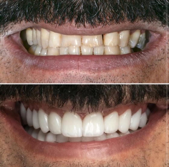 Full-mouth smile makeover: before and after