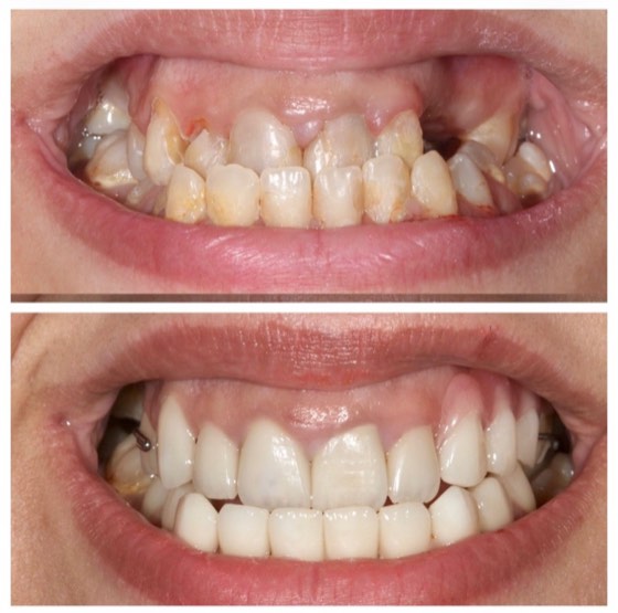 Smile makeover: before and after