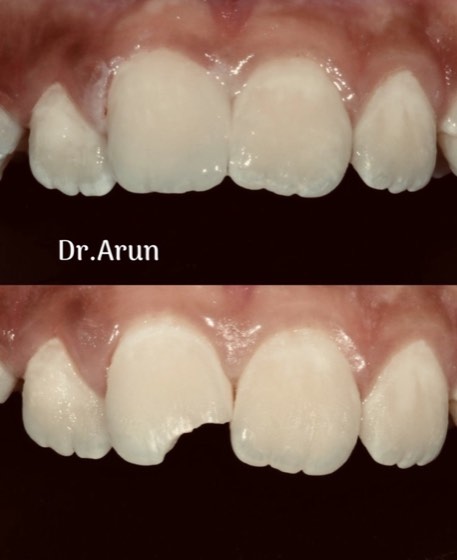 Chipped tooth composite repair: before and after