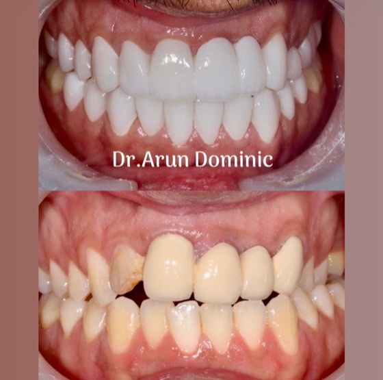 Full-mouth ceramic crowns: before and after