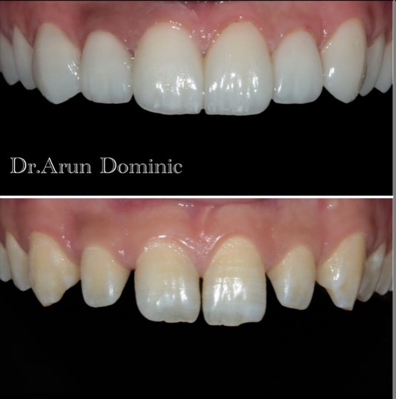 Veneers: before and after