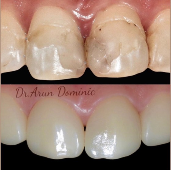 Porcelain crowns: before and after