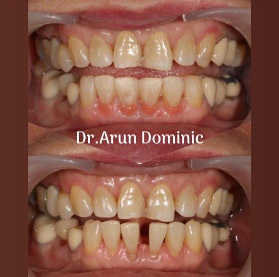Anterior composite restoration: before and after