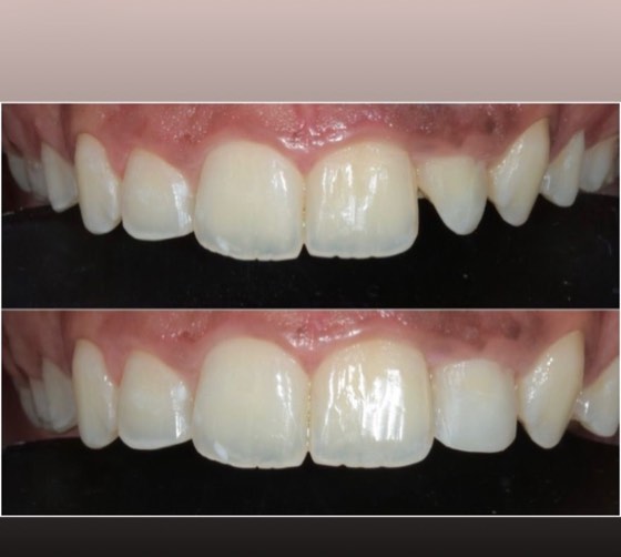 Composite filling: before and after