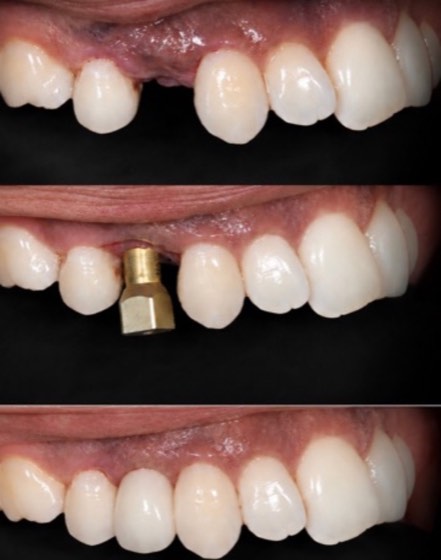 Implant in 3 stages: before and after