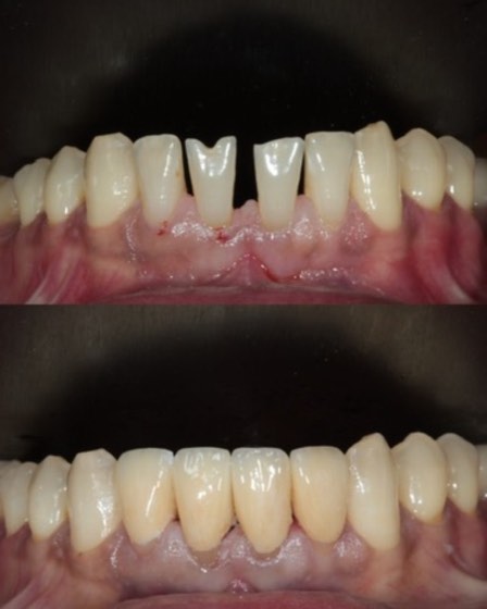 Lower front teeth restoration: before and after