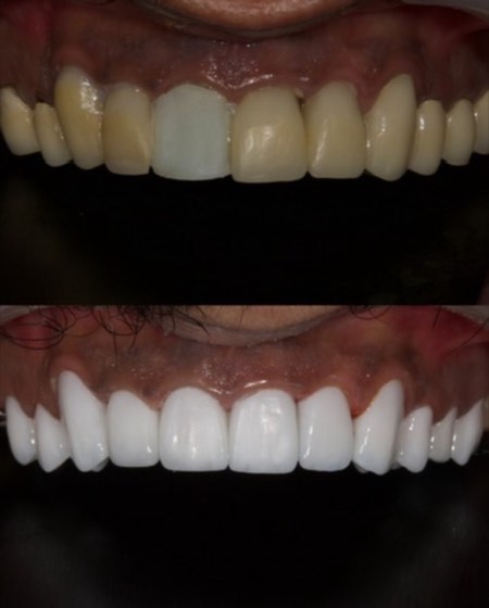 Full-arch veneers: before and after