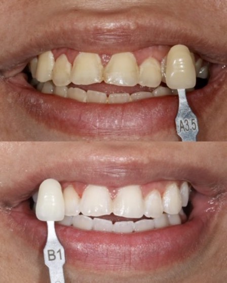 Teeth whitening (shade change): before and after