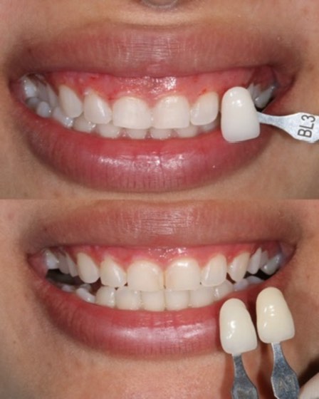 Teeth whitening (shade change): before and after