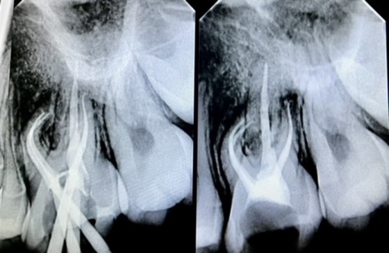 Root canal treatment (X-ray): before and after